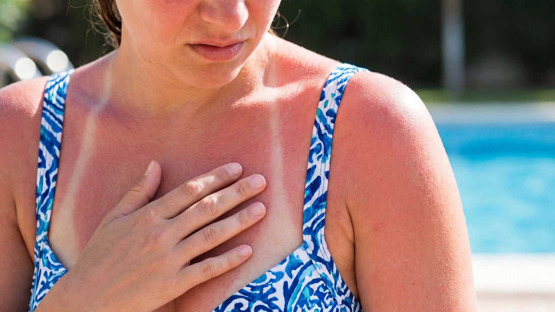 Que faire pour les coups de soleil ?